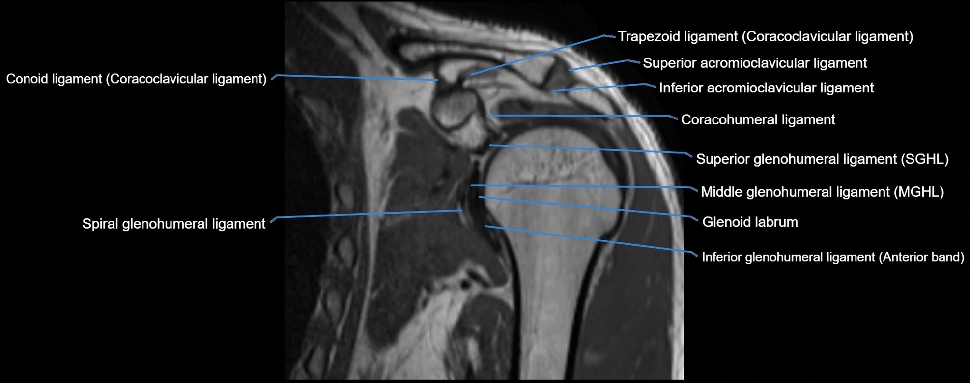 shoulder ligments coronal  cross sectional anatomy 3T MRI AI enhanced radiology image -img-00001-00020.webp